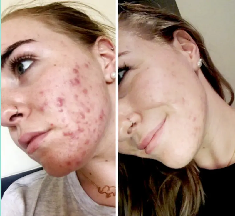 best-natural-skin-products-for-acne
